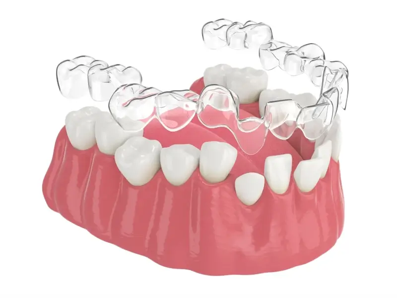 Czym się różni Clear Aligner od Invisalign?