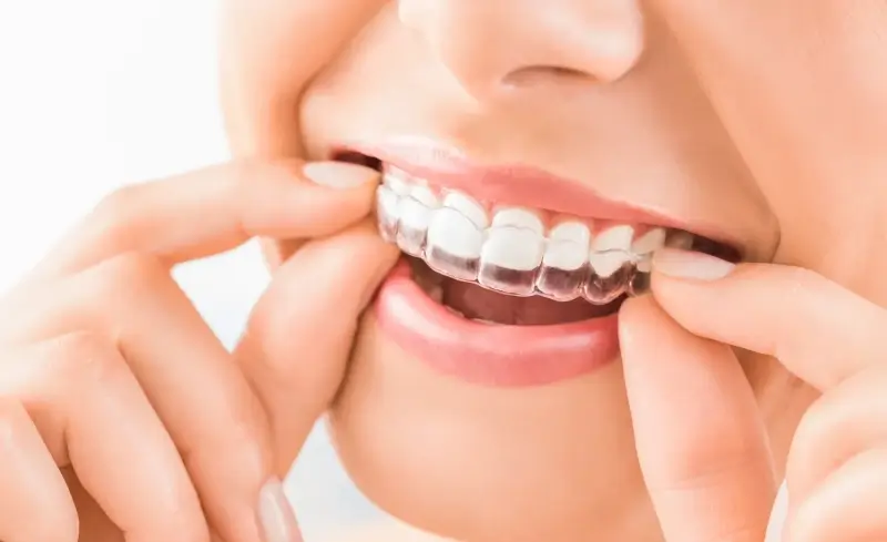 Jak się przygotować do wszczepienia implantów zębów?